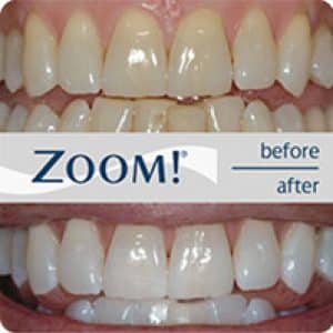 ZOOM Teeth Whitening Medical Lake WA